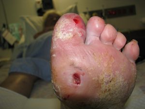 diabetes-related foot disease